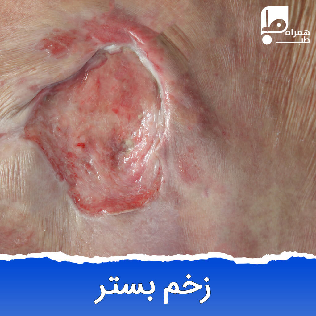 زخم بستر چیست