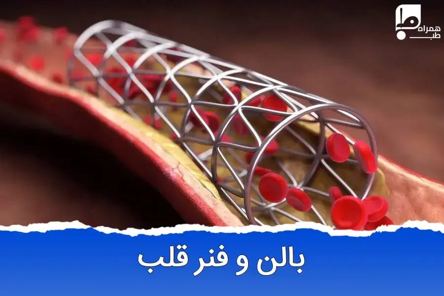 انتخاب روش مناسب برای درمان بیماری‌های قلبی: بالن یا فنر؟