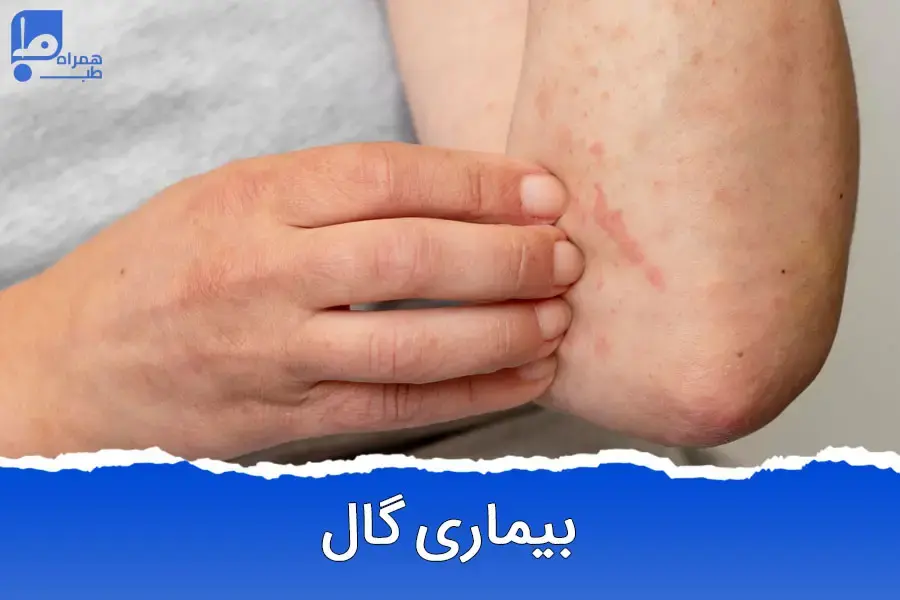 بیماری گال چیست و چگونه درمان می‌شود؟